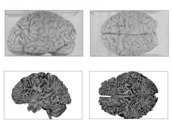 Mozog zdravého človeka (hore) a mozog alkoholika s nezvratnými následkami (dole)
